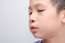 Chảy máu cam ở trẻ