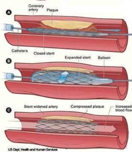 Điều trị tim mạch bằng cách đặt stent mạch vành