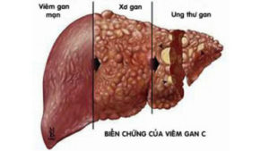 che do dinh duong cho benh nhan bi viem gan