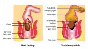 Bệnh táo bón ở trẻ em