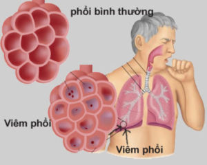 bệnh viêm phổi
