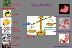 Tiêu hóa- Biến chứng viêm loét dạ dày tá tràng