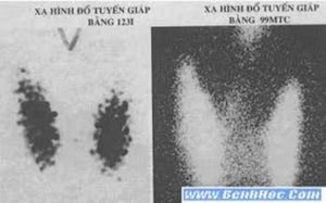Xạ hình đồ tuyến giáp