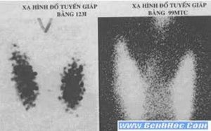 Xạ hình đồ tuyến giáp